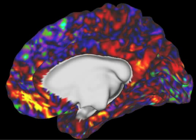 XNef、AIでうつ病診断 脳画像解析、精度向上 | 日刊工業新聞 電子版